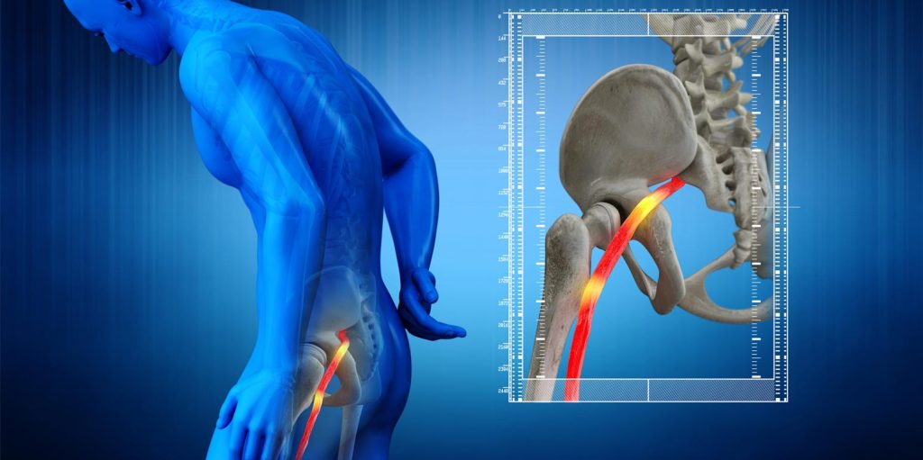 Bel Ağrılarına Son: Doğal Yöntemlerle Siyatik Tedavisi Hakkında Bilmeniz Gerekenler
